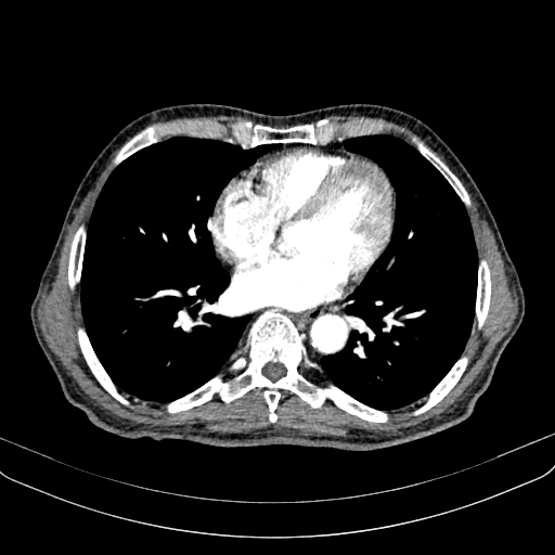 Abdominal aortic aneurysm (Radiopaedia 83581-98689 Axial C+ arterial phase 2).jpg