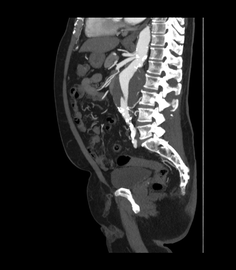 Abdominal aortic aneurysm with thrombus fissuration (Radiopaedia 46218-50618 Sagittal C+ arterial phase 33).jpg