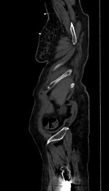 Abdominal aortic aneurysm with thrombus fissuration (Radiopaedia 73192-83919 Sagittal C+ arterial phase 134).jpg