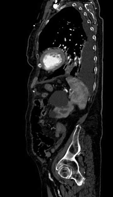 Abdominal aortic aneurysm with thrombus fissuration (Radiopaedia 73192-83919 Sagittal C+ arterial phase 29).jpg
