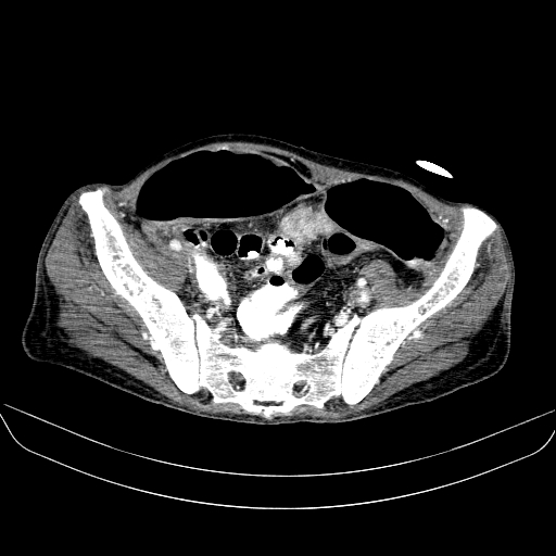 File:Abdominal collection due to previous cecal perforation (Radiopaedia 80831-94320 Axial C+ portal venous phase 164).jpg
