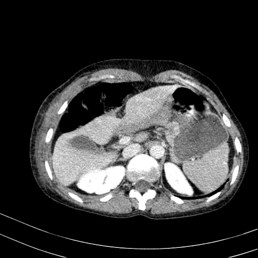 Abdominal wall hematoma with active bleeding (Radiopaedia 83915-99117 Axial C+ portal venous phase 3).jpg