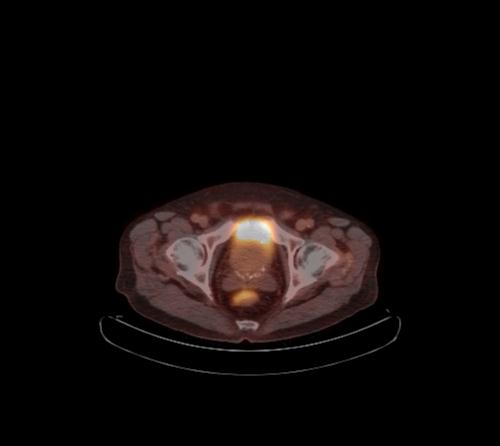 File:Abdominal wall metastasis from colorectal carcinoma (Radiopaedia 31016-31719 C 25).jpg