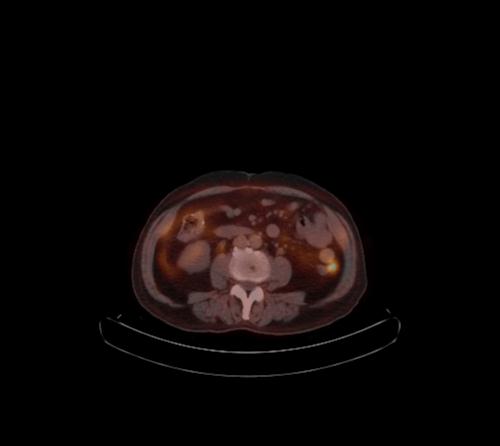 Abdominal wall metastasis from colorectal carcinoma (Radiopaedia 31016-31719 C 59).jpg