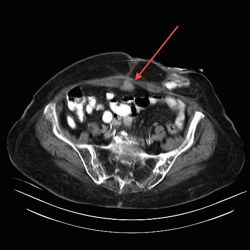 File:Abdominal wall recurrence after colorectal resection for cancer (Radiopaedia 23444-23524 B 1).jpg