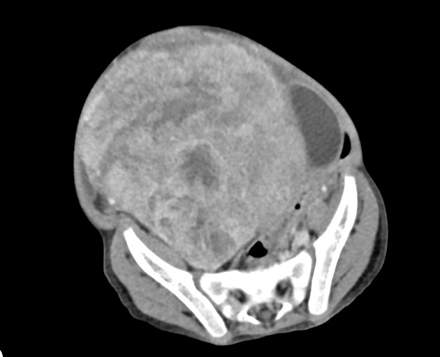 Abdominopelvic rhabdomyosarcoma (Radiopaedia 78356-90984 Axial C+ portal venous phase 128).jpg