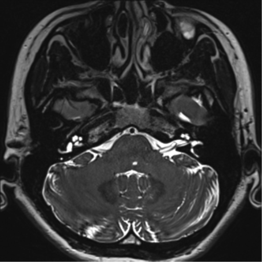 File:Abducens nerve palsy (Radiopaedia 51069-56648 Axial T2 fat sat 18).png