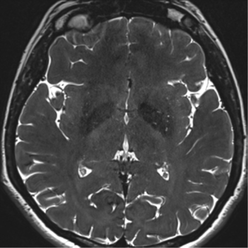 Abducens nerve palsy (Radiopaedia 51069-56648 Axial T2 fat sat 95).png
