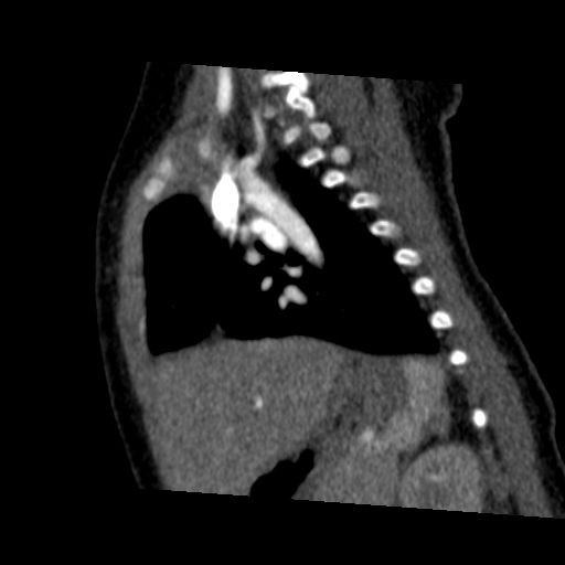 File:Aberrant left pulmonary artery (pulmonary sling) (Radiopaedia 42323-45435 Sagittal C+ arterial phase 35).jpg