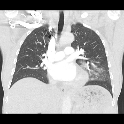 Accessory left horizontal fissure with lingular pneumonia (Radiopaedia 53763-59843 Coronal lung window 23).jpg