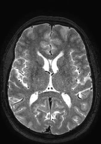 File:Accessory middle cerebral artery (Radiopaedia 73114-83828 Axial T2 58).jpg