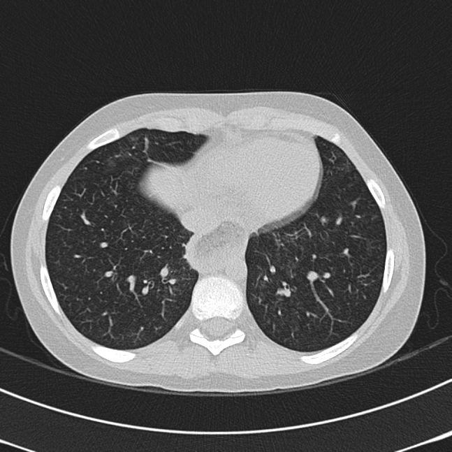Achalasia (Radiopaedia 14946-14878 Axial lung window 58).jpg