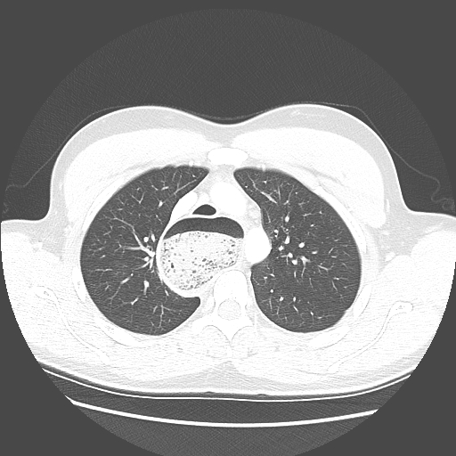 Achalasia (Radiopaedia 52507-58417 Axial lung window 19).jpg
