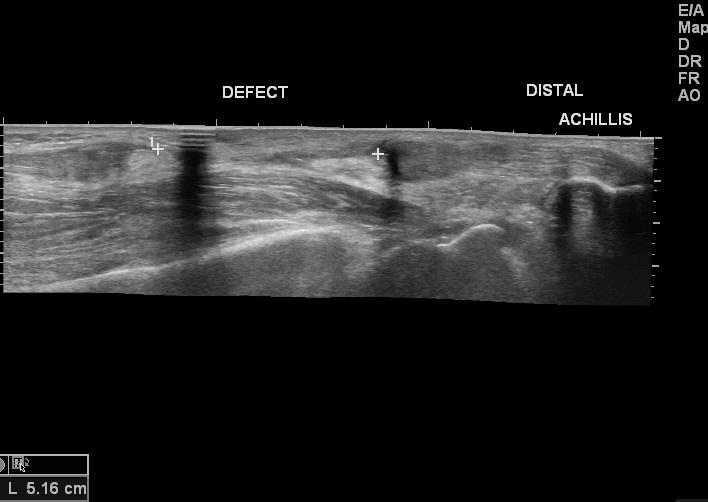 File:Achilles tendon tear (Radiopaedia 18551-18421 C 1).jpg