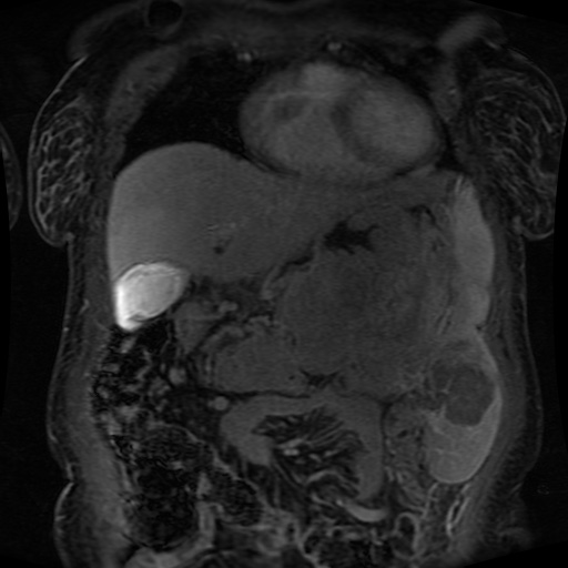 Acinar cell carcinoma of the pancreas (Radiopaedia 75442-86668 Coronal T1 C+ fat sat 137).jpg