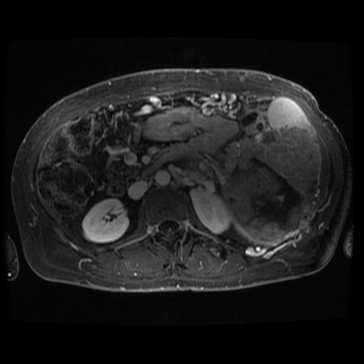 Acinar cell carcinoma of the pancreas (Radiopaedia 75442-86668 D 38).jpg