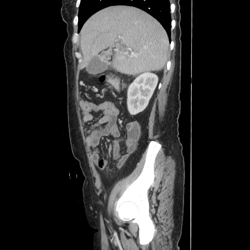 Acinar cell carcinoma of the pancreas (Radiopaedia 75442-86669 Sagittal C+ portal venous phase 61).jpg