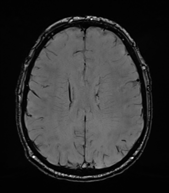 Acoustic schwannoma (Radiopaedia 50846-56358 Axial SWI 62).png