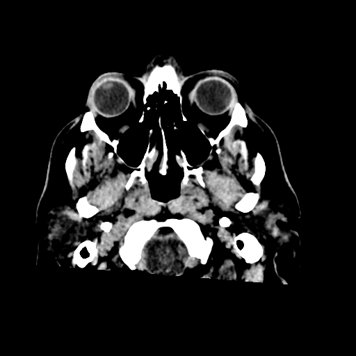 File:Acoustic schwannoma (Radiopaedia 55729-62280 Axial non-contrast 4).png