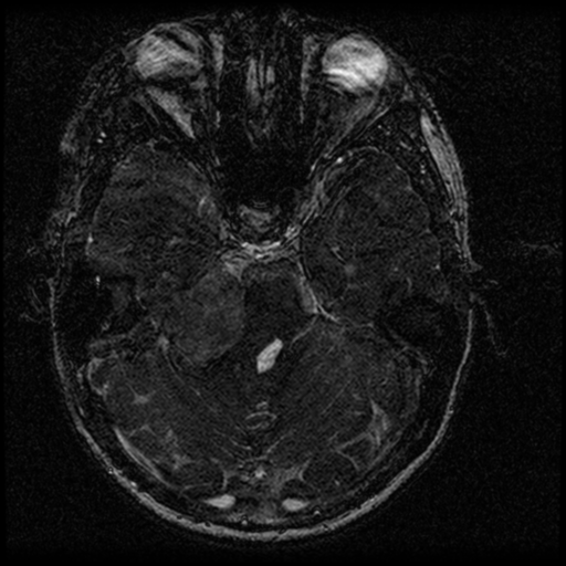 Acoustic schwannoma - eroding petrous apex (Radiopaedia 39674-42004 Axial T2 64).png