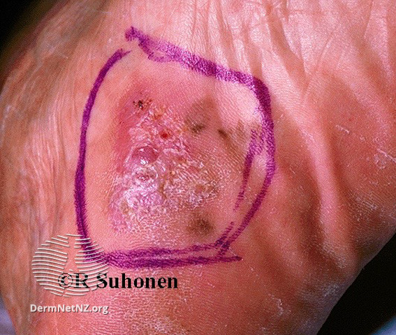 File:Acral lentignous melanoma (DermNet NZ lesions-melanoma-s-alm5).jpg