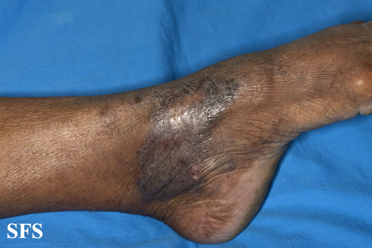 File:Acroangiodermatitis (Dermatology Atlas 1).jpg
