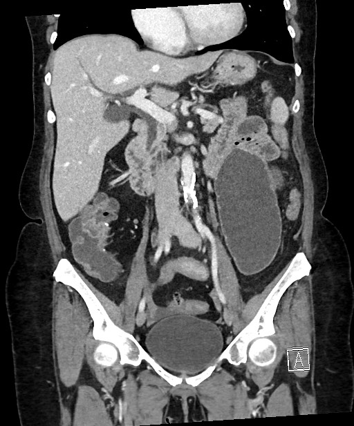 Active Crohn disease (Radiopaedia 59394-66750 Coronal C+ portal venous phase 36).jpg