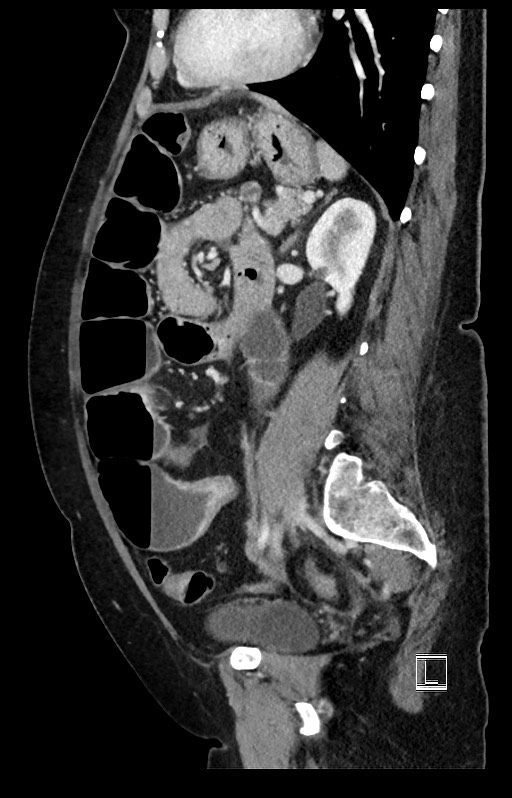 Active Crohn disease (Radiopaedia 59394-66750 Sagittal C+ portal venous phase 21).jpg
