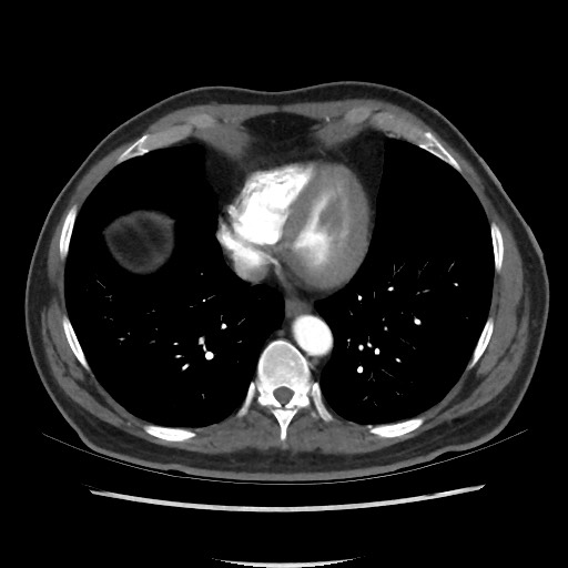 Active colonic bleed on CT (Radiopaedia 49765-55025 Axial C+ arterial phase 5).jpg