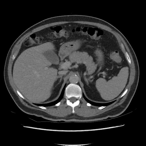 File:Active colonic bleed on CT (Radiopaedia 49765-55025 Axial C+ delayed 23).jpg