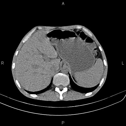 File:Active crohn disease (Radiopaedia 87133-103397 Axial non-contrast 20).jpg