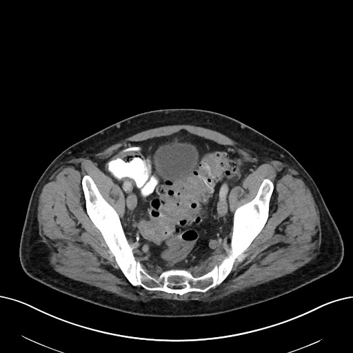 File:Active lower gastrointestinal bleeding - diverticular (Radiopaedia 61203-69106 Axial C+ portal venous phase 106).jpg