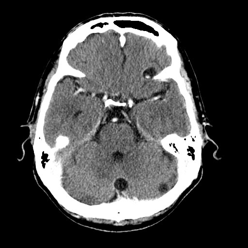 File:Active neurocysticercosis before and after therapy (Radiopaedia 71710-82099 Axial C+ delayed 72).jpg
