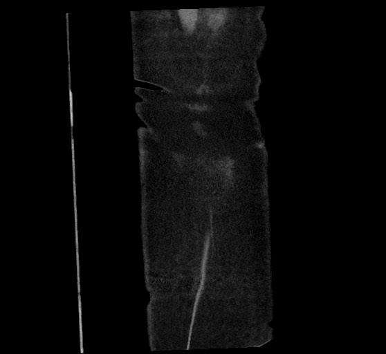 Active renal extravasation with large subcapsular and retroperitoneal hemorrhage (Radiopaedia 60975-68796 Coronal C+ arterial phase 147).jpg