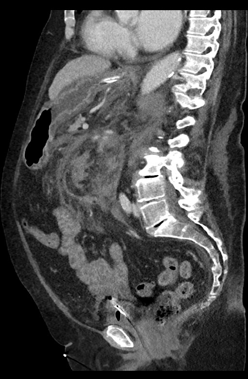 Active renal extravasation with large subcapsular and retroperitoneal hemorrhage (Radiopaedia 60975-68796 Sagittal C+ portal venous phase 112).jpg