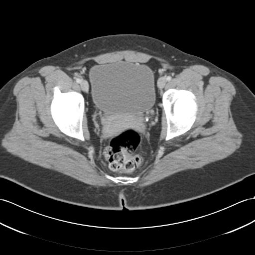 File:Acute appendicitis (Radiopaedia 30297-30934 Axial C+ portal venous phase 75).jpg