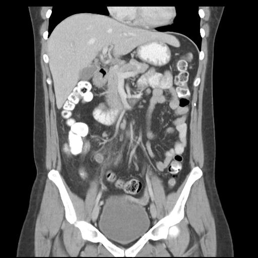 File:Acute appendicitis (Radiopaedia 30297-30934 Coronal C+ portal venous phase 20).jpg