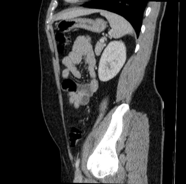 Acute appendicitis (Radiopaedia 38255-40270 Sagittal C+ portal venous phase 61).jpg