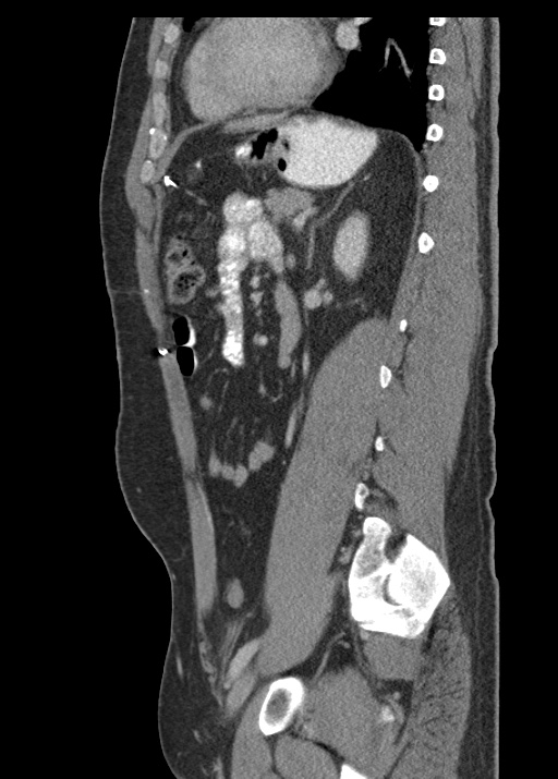 Acute appendicitis (Radiopaedia 48511-53463 Sagittal C+ portal venous phase 87).jpg