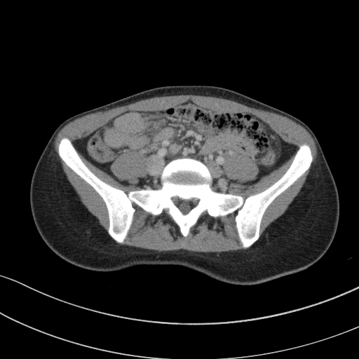 Acute appendicitis (Radiopaedia 62608-70901 Axial C+ portal venous phase 7).jpg