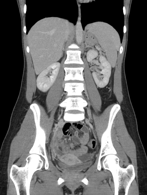 Acute appendicitis (Radiopaedia 62608-70901 Coronal C+ portal venous phase 31).jpg