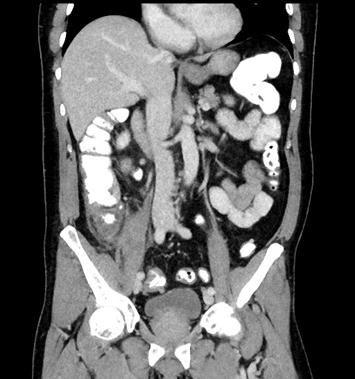Acute appendicitis (Radiopaedia 77016-88960 Coronal C+ portal venous phase 51).jpg