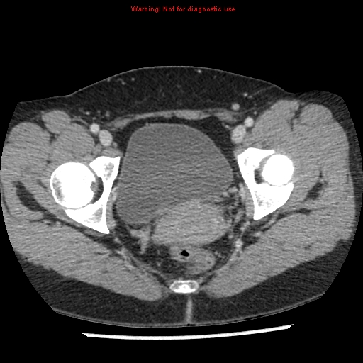 File:Acute appendicitis (Radiopaedia 7966-8812 C+ portal venous phase 52).jpg