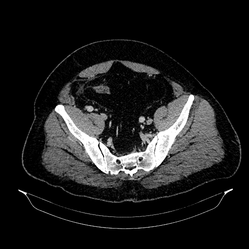 File:Acute appendicitis (Radiopaedia 79950-93224 Axial C+ portal venous phase 84).jpg
