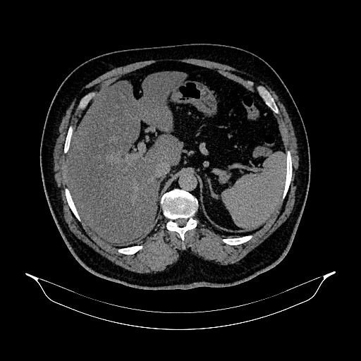 Acute appendicitis (Radiopaedia 79950-93224 Axial non-contrast 26).jpg