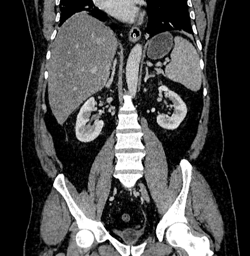 Acute appendicitis (Radiopaedia 79950-93224 Coronal C+ portal venous phase 56).jpg