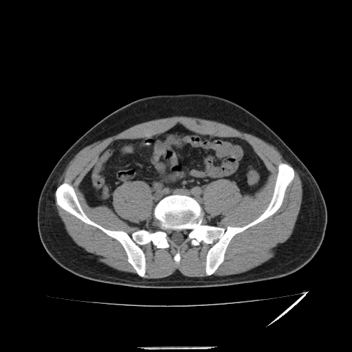 Acute appendicitis (Radiopaedia 81320-95015 A 3).jpg