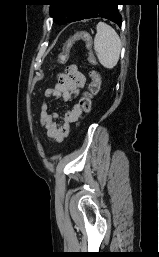 Acute appendicitis - large appendicoliths (Radiopaedia 61805-69820 Sagittal C+ portal venous phase 19).jpg