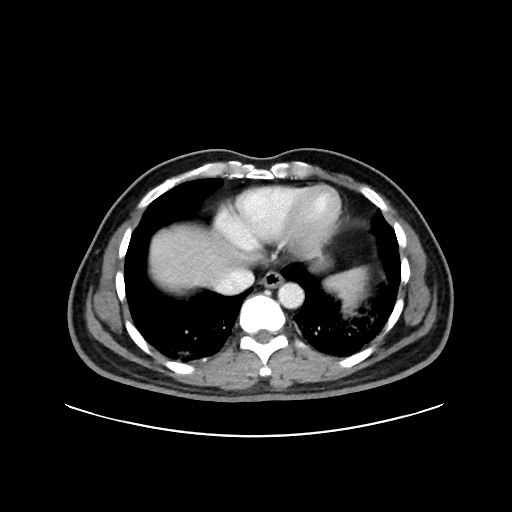 Acute appendicitis and COVID 19 pneumonia (Radiopaedia 76604-88380 Axial C+ portal venous phase 5).jpg
