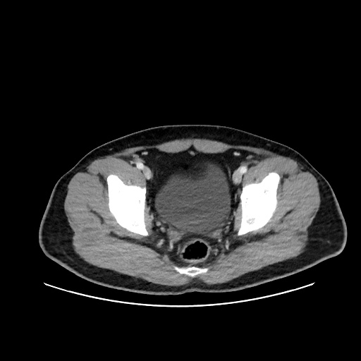 Acute appendicitis and COVID 19 pneumonia (Radiopaedia 76604-88380 Axial C+ portal venous phase 76).jpg